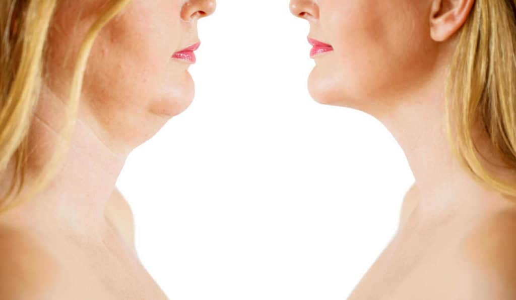 Double Chin treatment Willenhall before and after results