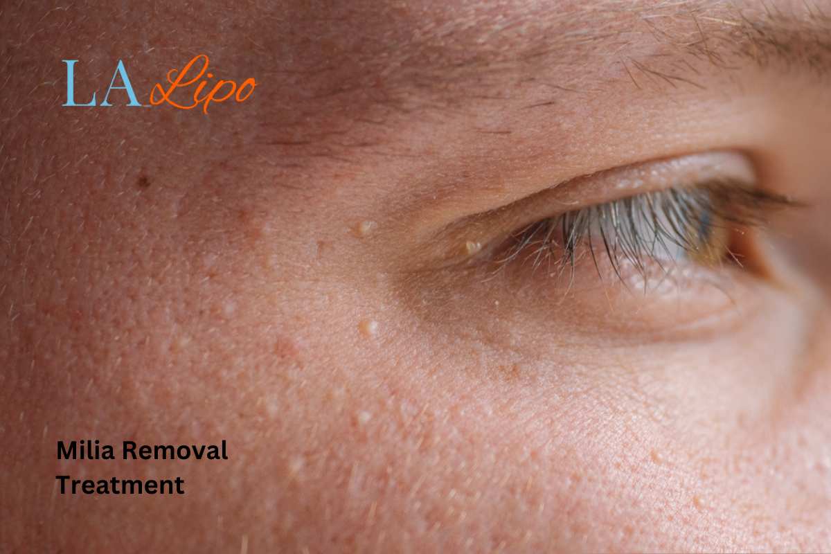 Cryopen Milia Removal: Is It the Easiest and Safest Option Willenhall?