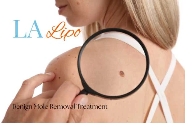 Woman having her inspection of blemish before mole removal Willenhall