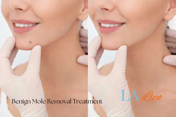 woman's before and after mole removal Willenhall results