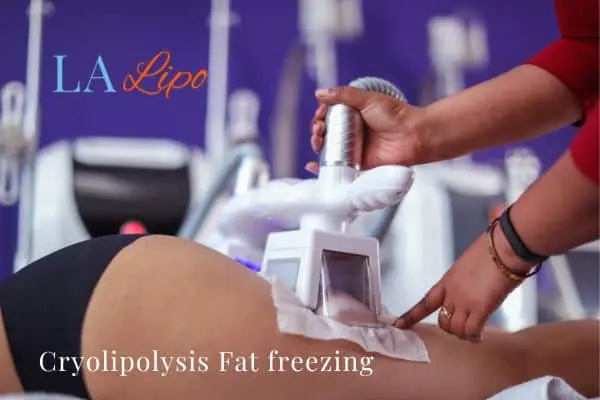 women getting fat freezing Willenhall