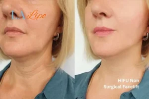 hi-fu for wrinkles Willenhall before and after results
