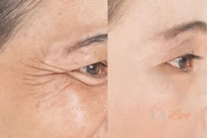 Before and after results of woman - HI-fu wrinkles reduction treatment Willenhall