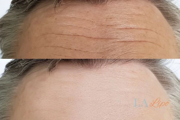 results of HIFU Willenhall on mans forehead to help reduce lines and wrinkles