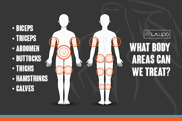 Graphic to show areas you can have LA-EMS Body Sculpting Willenhall treatment.