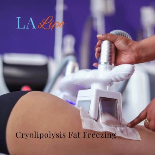 fat freezing - Cryolipolysis Willenhall