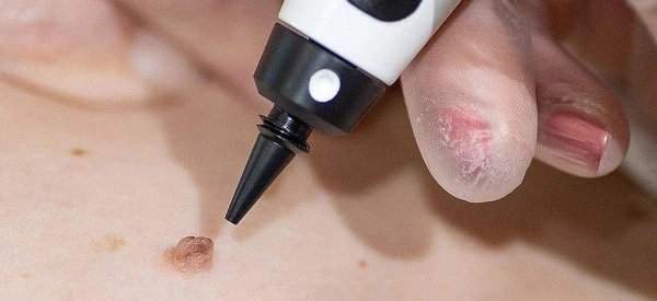 skin tag removal using cryopen Willenhall