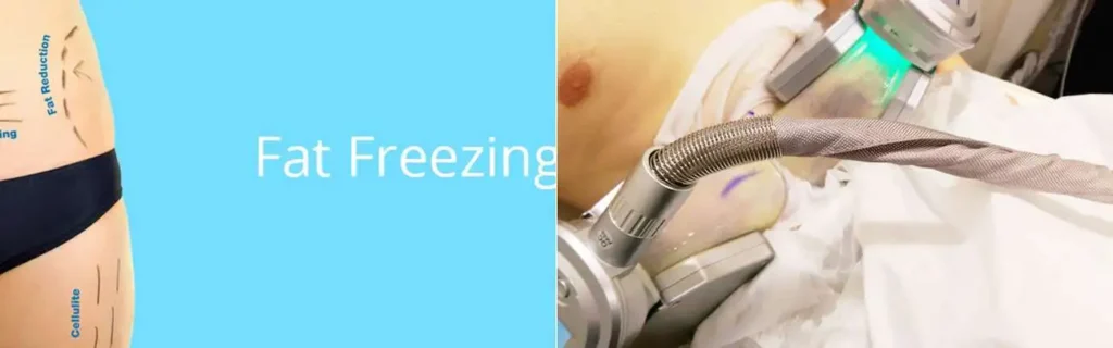 Fat freezing Willenhall on multiple areas of the body