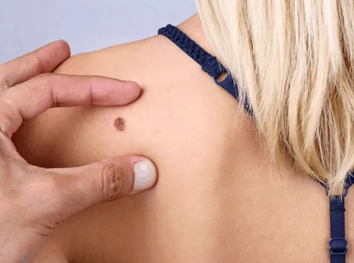 woman having mole removal Willenhall consultation before treatment.