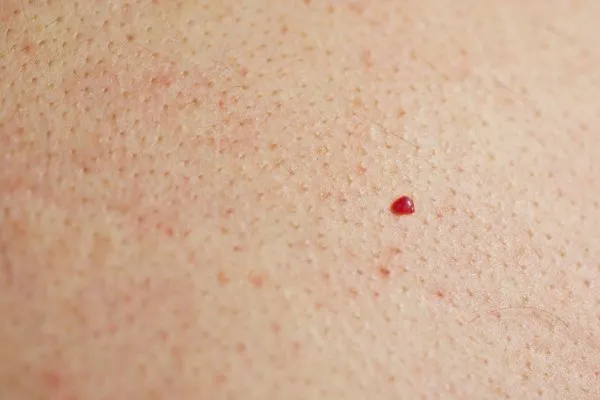 close up of a cherry angioma Willenhall