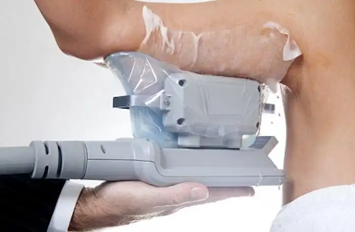 Picture of fat freezing Willenhall on the upper arms.