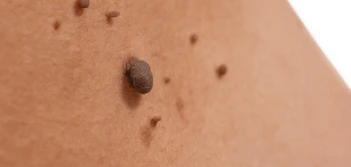 image of a skin tag Willenhall