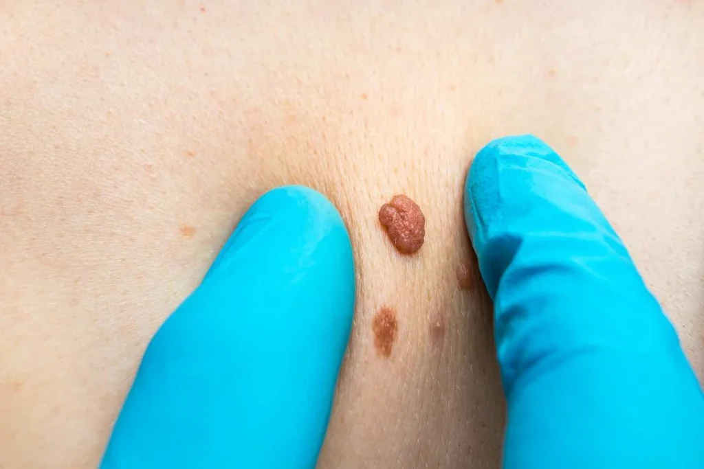 Consultant examining a skin tag Willenhall