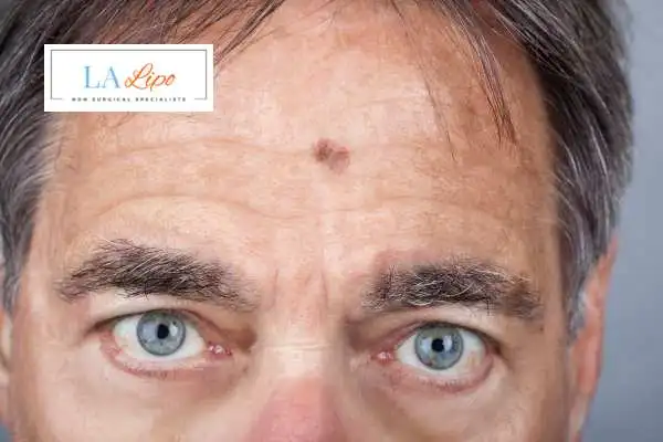 Solar Lentigo Removal Willenhall image of man with mark on his forehead