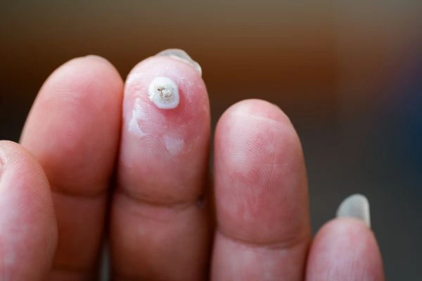wart on person finger - cryotherapy to treat from LA LIPO Willenhall