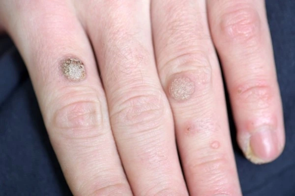 photo of warts on person hand - see wart removal Willenhall from LA LIPO