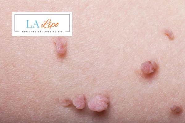 Does cryopen skin tag removal Willenhall hurt? Find out now call our team today!