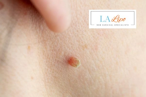 Book skin tag removal Willenhall today speak to our team now!