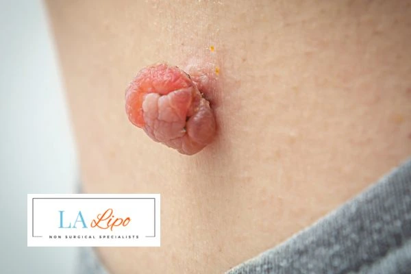 Interested in skin tag removal Willenhall? Concerned about the pain? Find out more today!