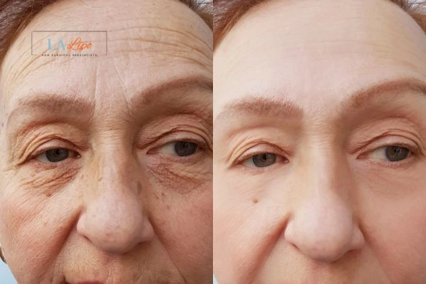 The powerful benefits of Morpheus8 Treatment Willenhall - Call Our team today!