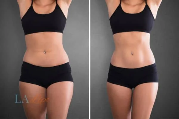 before and after results of non-surgical treatment to help a woman's body image and mental health Willenhall