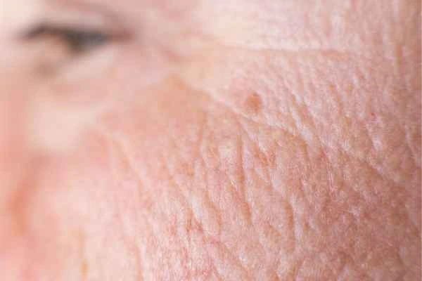 close up picture of a woman's face showing an age spot Willenhall