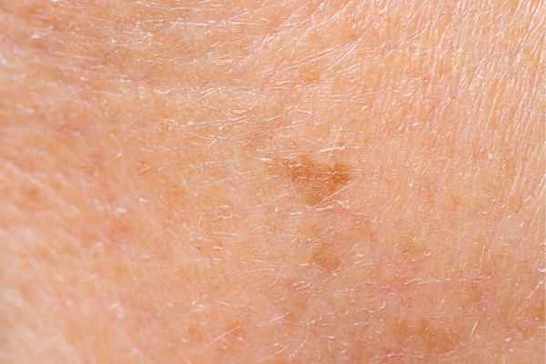 close up picture of age spots Willenhall