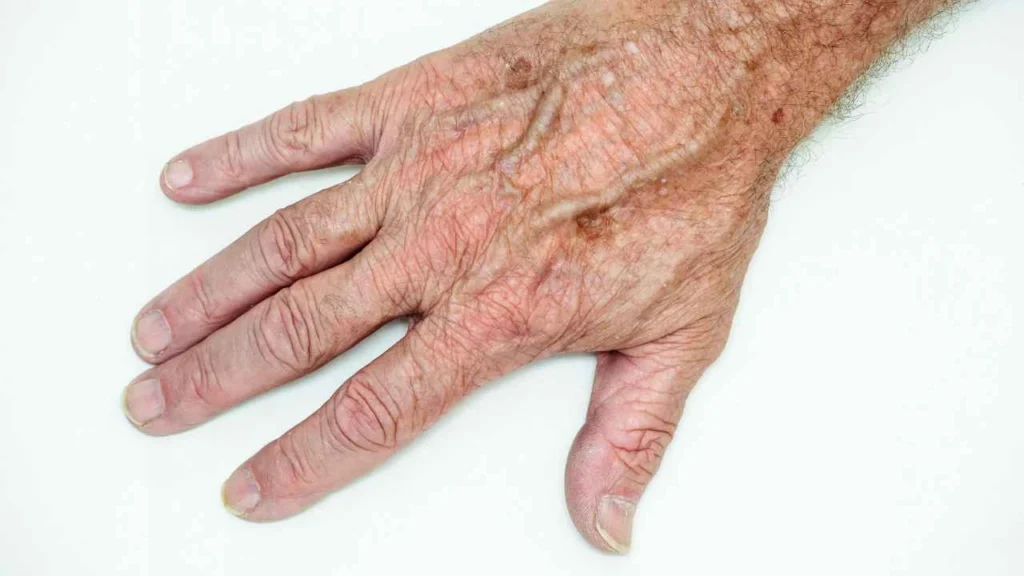 Male hand showing age spot Willenhall