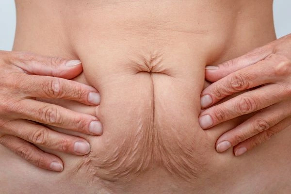 Image of a woman's stomach with loose skin - example of skin tightening Willenhall options