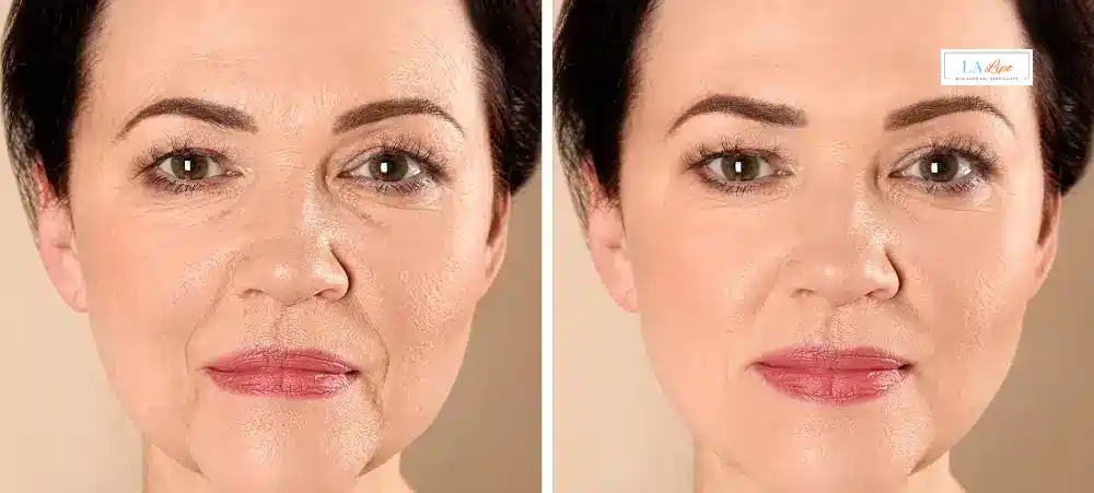How Long Does It Take to See Results and How Long Do They Last Willenhall?