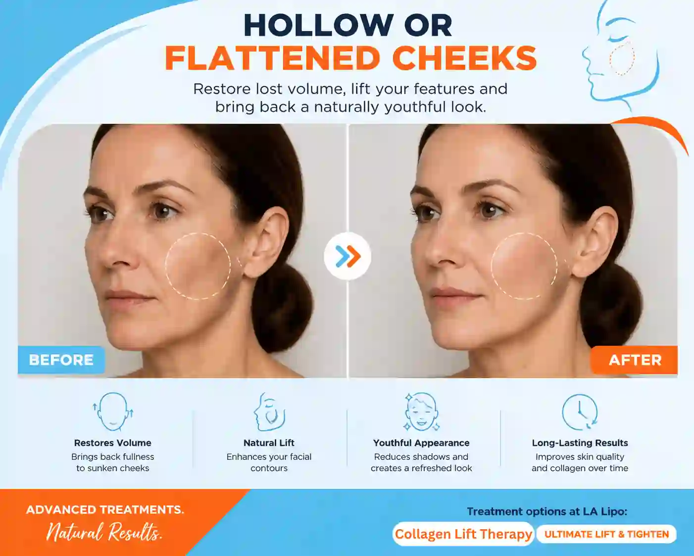 Sign #4: Hollow or Flattened Cheeks Willenhall